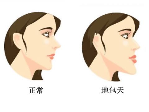什么是地包天？地包天長(zhǎng)什么樣子？地包天牙齒圖片