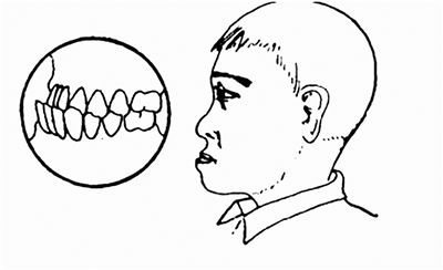 什么是地包天？地包天長(zhǎng)什么樣子？地包天牙齒圖片