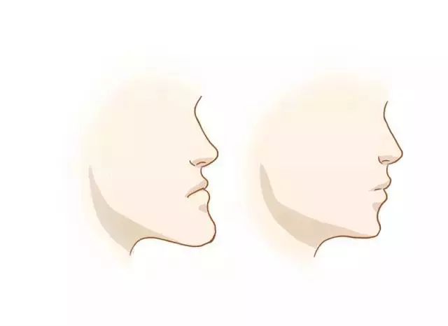 什么是地包天？地包天長(zhǎng)什么樣子？地包天牙齒圖片